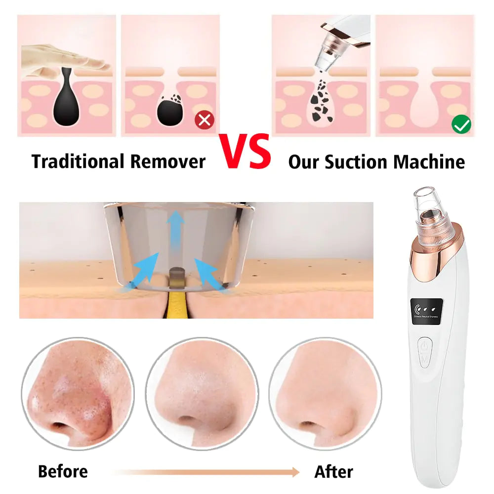 Beauty Electric Blackhead Remover - Gentle Vacuum Suction for Clearer Skin
