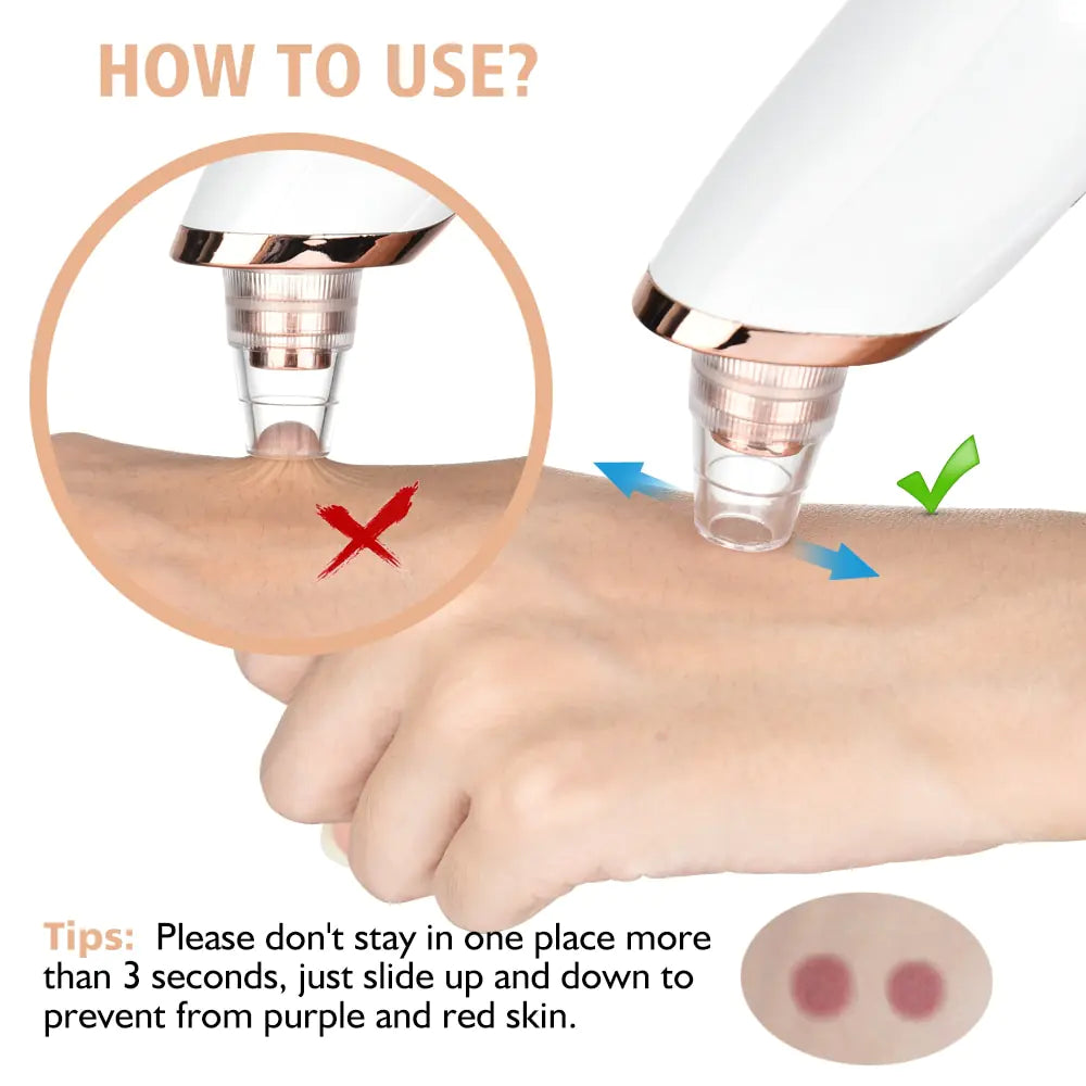 Beauty Electric Blackhead Remover - Gentle Vacuum Suction for Clearer Skin