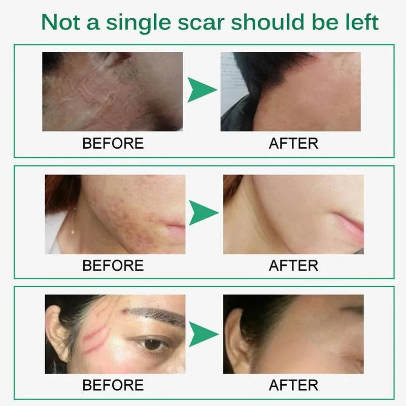 Scar Removal Cream - Achieve Smoother, Radiant Skin
