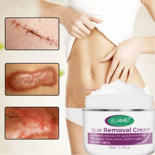 Scar Removal Cream - Achieve Smoother, Radiant Skin