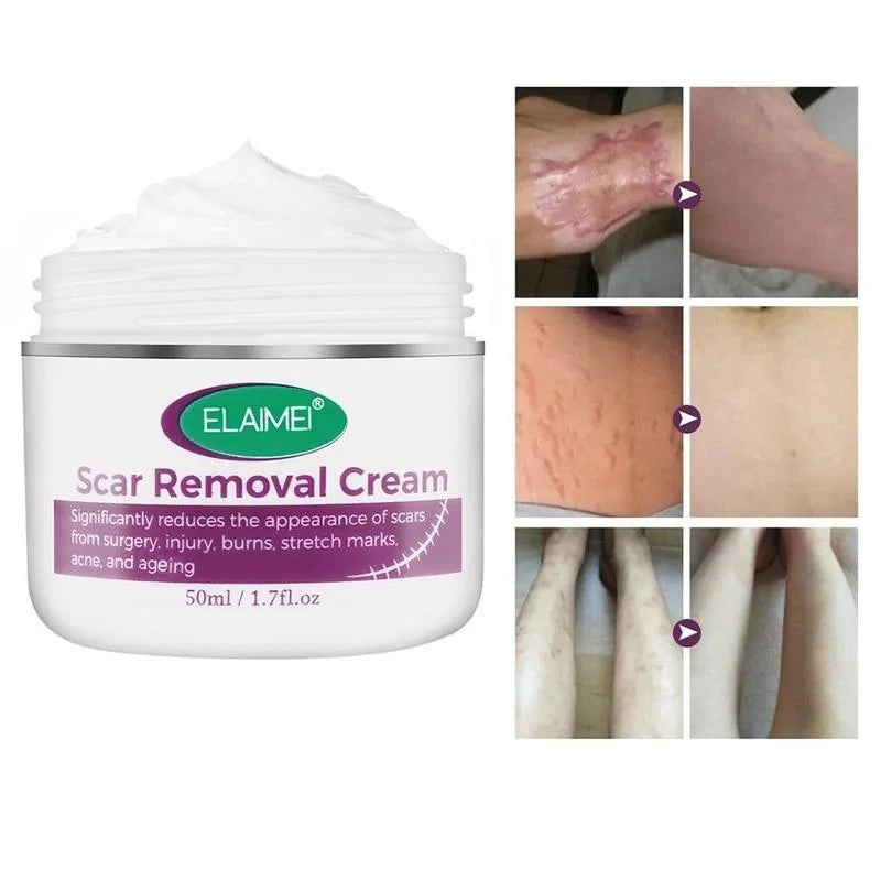 Scar Removal Cream - Achieve Smoother, Radiant Skin